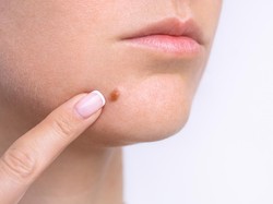 5 Cara Agar Jerawat Cepat Matang dengan Aman dan Efektif