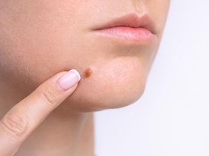 5 Cara Agar Jerawat Cepat Matang dengan Aman dan Efektif 5 Cara Agar Jerawat Cepat Matang dengan Aman dan Efektif
