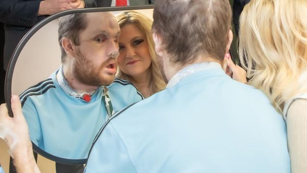 Foto Pria yang Jalani Transplantasi Wajah, Begini Penampilan Terbarunya