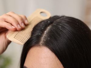 8 Penyebab Ketombe Basah yang Perlu Dipahami dan Cara Menghilangkannya 8 Penyebab Ketombe Basah yang Perlu Dipahami dan Cara Menghilangkannya