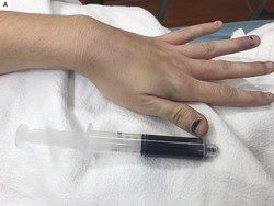 Penampakan Darah Wanita Berubah gegara Efek Obat, Darahnya Literally Biru!