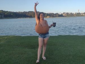 Wanita Ini Mengidap Penyakit Aneh, Payudara Terus Membesar hingga 10 Kg