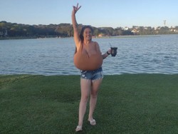 Wanita Ini Mengidap Penyakit Aneh, Payudara Terus Membesar hingga 10 Kg