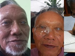 Kisah Achmad Kembali Melihat Dunia Usai Jalani Donor Mata