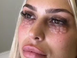 Bahaya Prosedur Kecantikan yang Punya Efek Samping Wajah Seperti Reptil Bahaya Prosedur Kecantikan yang Punya Efek Samping Wajah Seperti Reptil