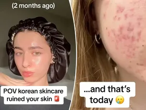 Wajah Jerawatan Gara-gara Tips Skincare Influencer, Dokter Beri Peringatan Ini Wajah Jerawatan Gara-gara Tips Skincare Influencer, Dokter Beri Peringatan Ini