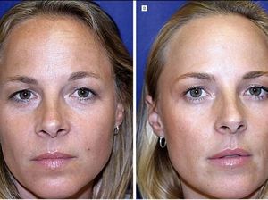 Saudari Kembar Ini Jalani Eksperimen Botox, Bisa Tebak Mana yang Melakukan?