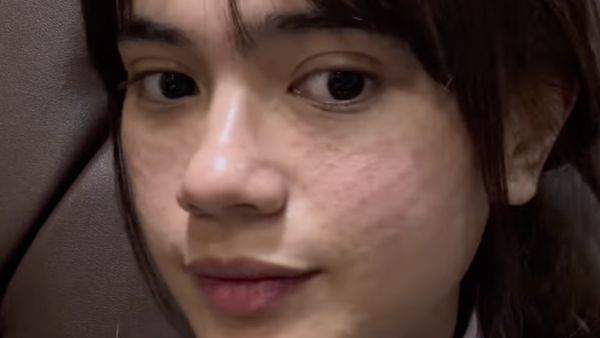 Foto Audi Marissa Perawatan Rp 42 Juta di Korea, Before After-nya Bikin Kaget