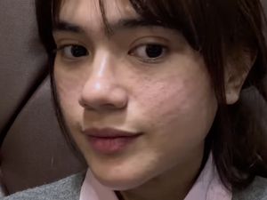 Foto Audi Marissa Perawatan Rp 42 Juta di Korea, Before After-nya Bikin Kaget