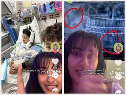 Duh! Rahang Remaja Ini Patah Usai Gigit Permen Pemecah Rahang