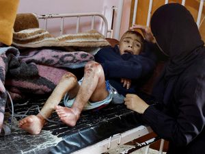 Potret Anak-anak Gaza yang Menderita Gizi Buruk