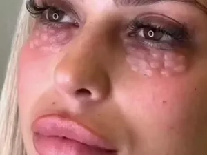 Viral Tren Kecantikan Atasi Mata Panda, Bikin Berakhir Jadi Bak Kulit Reptil Viral Tren Kecantikan Atasi Mata Panda, Bikin Berakhir Jadi Bak Kulit Reptil