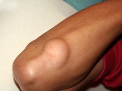 Apa Itu Uci-uci? Ini Penyebab, Ciri-ciri, dan Pengobatannya