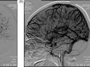 DSA Cerebral Mayapada Hospital: Solusi untuk Sakit Kepala Berkepanjangan