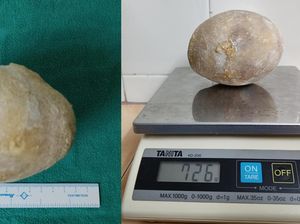 Ada Batu Kandung Kemih Raksasa di Perut Pria Ini, Ukurannya Bikin Melongo