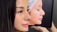 7 Foto Kirana Larasati Usai Rhinoplasty di Bangkok, Hidung Tak Lagi Bengkok