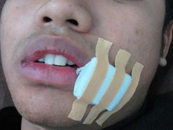 Pemotor Kena Jebakan Benang Nilon di Suramadu Dapat 5 Jahitan di Bibir