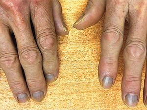 Kulit Kakek Ini Mendadak Berubah Jadi Abu-abu, Ternyata Ini Alasan Medisnya