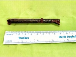 Sumpit Tersangkut di Rongga Mata Pria, Baru Ketahuan usai Muncul Gejala, Kok Bisa?