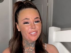 Eksperimen Tanning Berujung Fatal, Wajah Influencer Terbakar Hingga Terkelupas