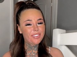 Eksperimen Tanning Berujung Fatal, Wajah Influencer Terbakar Hingga Terkelupas