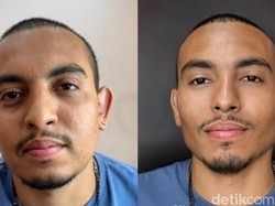 Transformasi Wajah Pria usai Operasi Plastik, Tampak Lebih Muda seperti Beda Orang