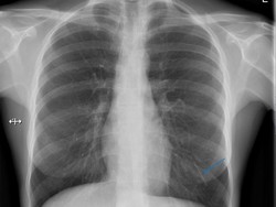 KB Implan di Lengan Mendadak Hilang, Tak Tahunya Nyasar ke Paru-paru