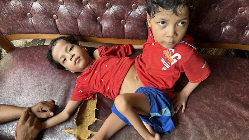 Kisah Kembar Siam Hidup dengan Perut Menyatu, Tetap Tegar Terima Takdir