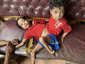 Kisah Kembar Siam Hidup dengan Perut Menyatu, Tetap Tegar Terima Takdir