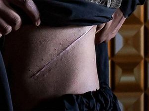 Kesaksian Warga Myanmar yang Jual-Beli Ginjal Demi Menyambung Hidup