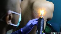Ratusan Orang Ikut Hapus Tato Gratis di Kantor Walikota Jakarta Timur