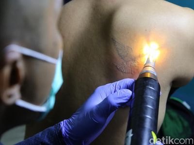 Ratusan Orang Ikut Hapus Tato Gratis di Kantor Walikota Jakarta Timur