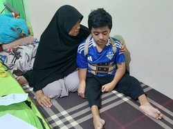 Yuk Bantu Kiki, Remaja Penderita Tulang Rapuh yang Sudah 16 Kali Operasi