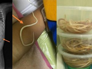 Bocah 3 Tahun di Jember Mengeluh Susah BAB, Ternyata Ususnya Dipenuhi Cacing Bocah 3 Tahun di Jember Mengeluh Susah BAB, Ternyata Ususnya Dipenuhi Cacing