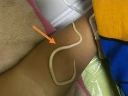 7 Fakta Ngeri 3 Stoples Cacing Bersarang di Perut Bocah 3 Tahun Jember