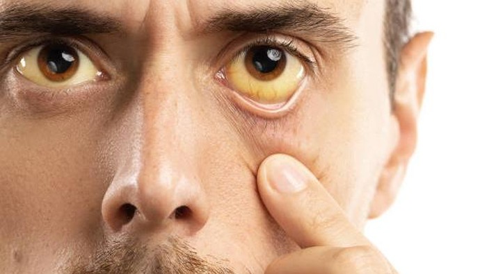 Man checking his health condition. Yellowish eyes is sign of problems with liver, booming  infection or other disease. memutihkan bola mata