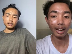 Bikin Pria Sakit Kulit, Dokter Soroti Penularan Penyakit dari Baju Thrifting