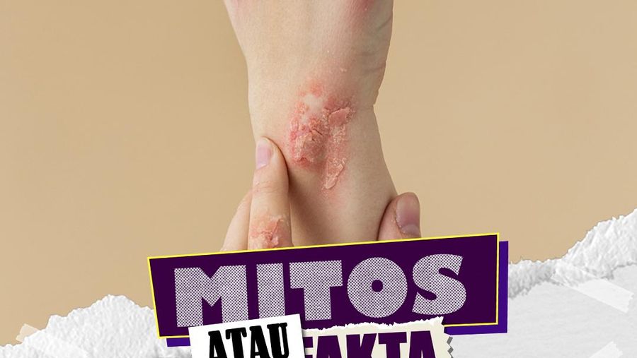 Video Mitos atau Fakta: Stres Tekanan Pekerjaan Memicu Eksim Kulit Lebih Parah