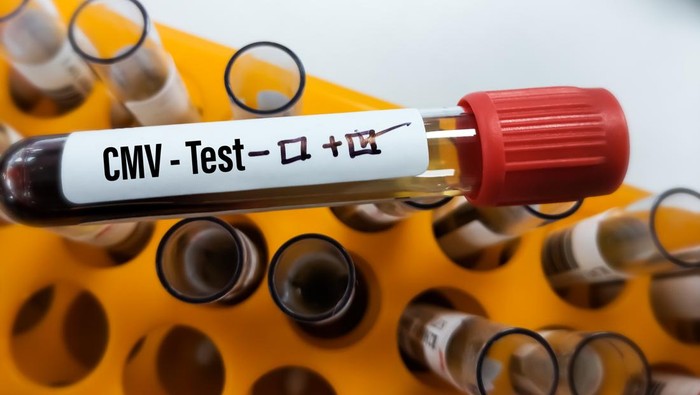 Blood sample positive with cytomegalovirus (CMV), laboratory background, focus view
