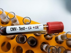 Infeksi Virus CMV Berpotensi Memperburuk Gejala Autisme