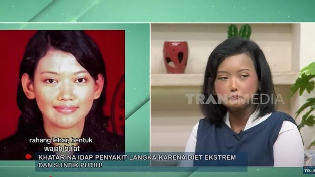 Khatrin Idap Penyakit Langka usai Diet
