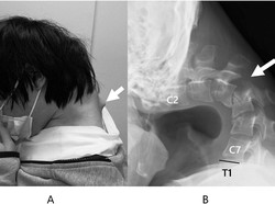 Efek Kecanduan Game Ponsel, Leher Pria Ini Bengkok