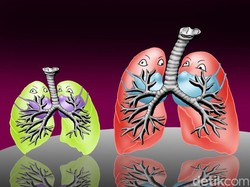 Kasus TBC di Sulsel Tembus 10.715 hingga Mei 2025, Makassar Tertinggi