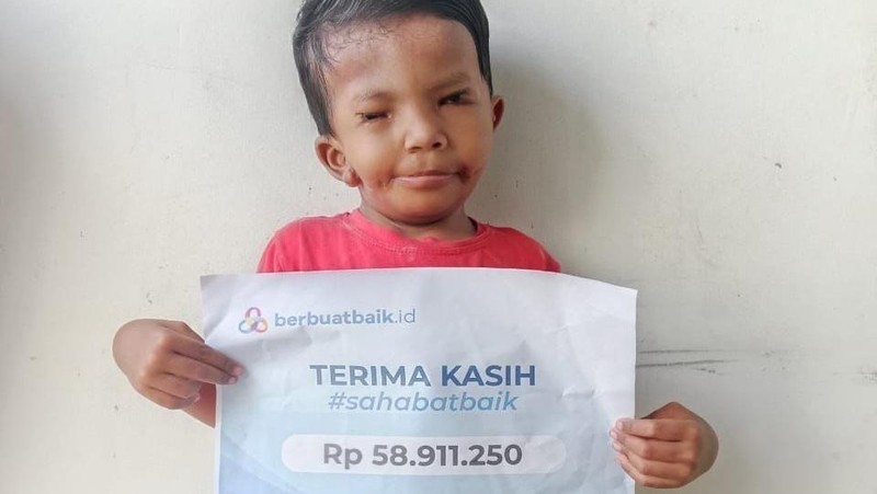 Dibantu Sahabat Baik, Kondisi Afriliam Membaik Usai Operasi Langit-langit Mulut