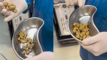 Sederet Kasus Medis 'Batu' di Tubuh Pasien, Ada di Ginjal hingga Miss V