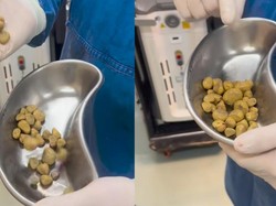 Cerita Dokter Berhasil Keluarkan 35 Batu Ginjal dari Pasien yang Doyan Minum Soda