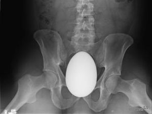 Hasil Foto X-Ray yang Bikin Geleng-geleng, Temuan Benda Aneh Nyangkut di Anus Hasil Foto X-Ray yang Bikin Geleng-geleng, Temuan Benda Aneh Nyangkut di Anus