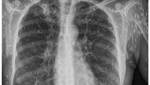 Foto Rontgen di Luar Nalar, Barang Aneh di Tubuh Termasuk Benda Diduga Susuk