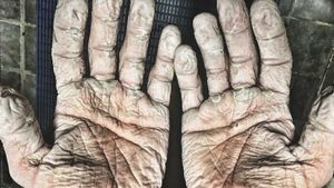 Asli! Ini Foto Kondisi Tubuh Manusia yang Bikin Merinding