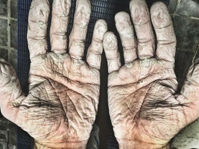 Asli! Ini Foto Kondisi Tubuh Manusia yang Bikin Merinding